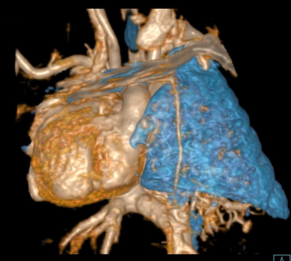 Collapsed Right Lung in Patient with Congenital Heart Disease - CTisus CT Scan