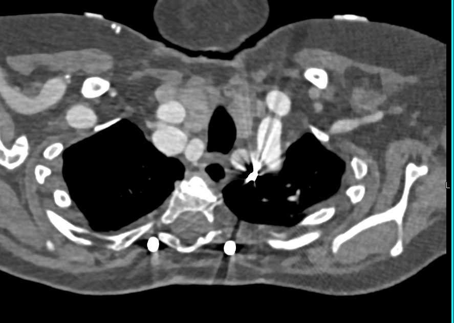 Extremely Extensive Tortuous Vessels off the Arch - CTisus CT Scan