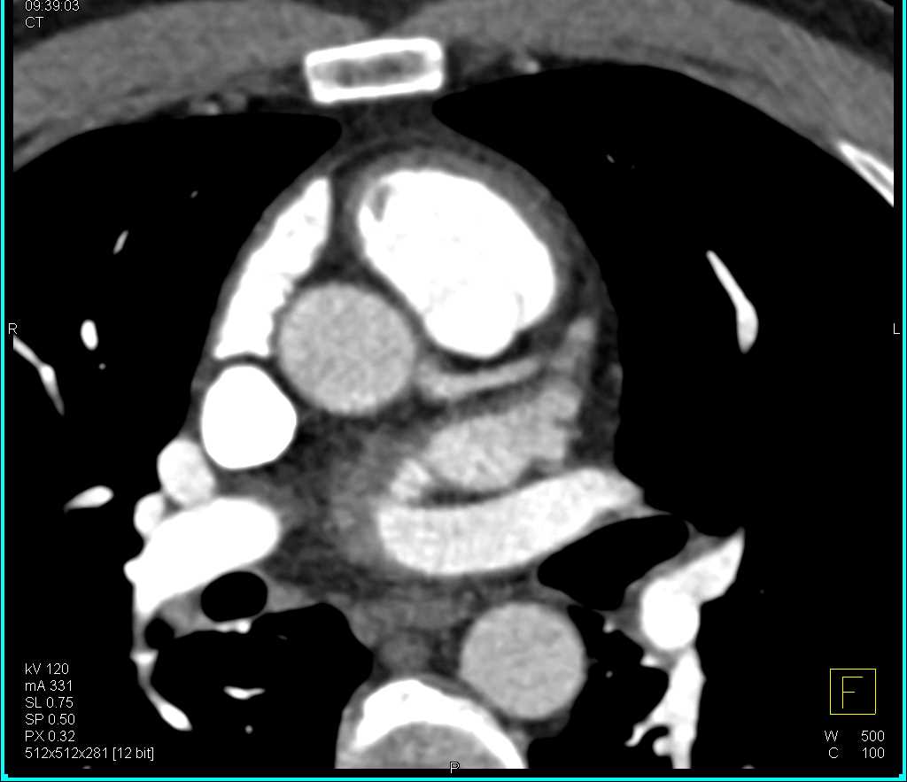 Poor Timing for a Cardiac CT - CTisus CT Scan