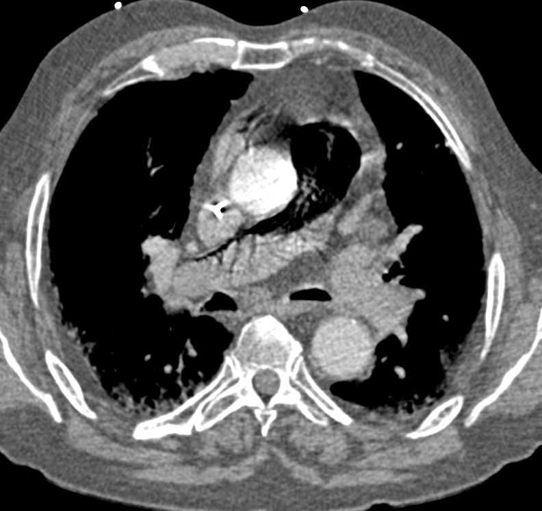 Massive Quantity of Air in Main Pulmonary Artery and in Heart Post Arrest - CTisus CT Scan