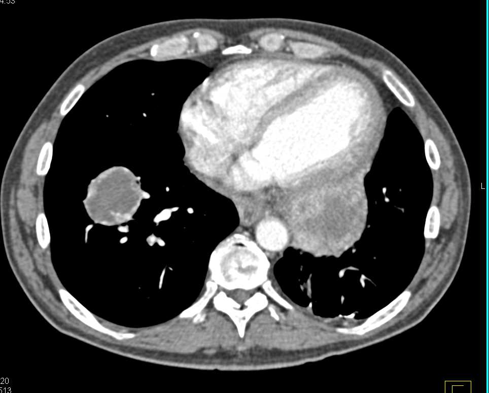 Melanoma Metastatic to the Heart - CTisus CT Scan