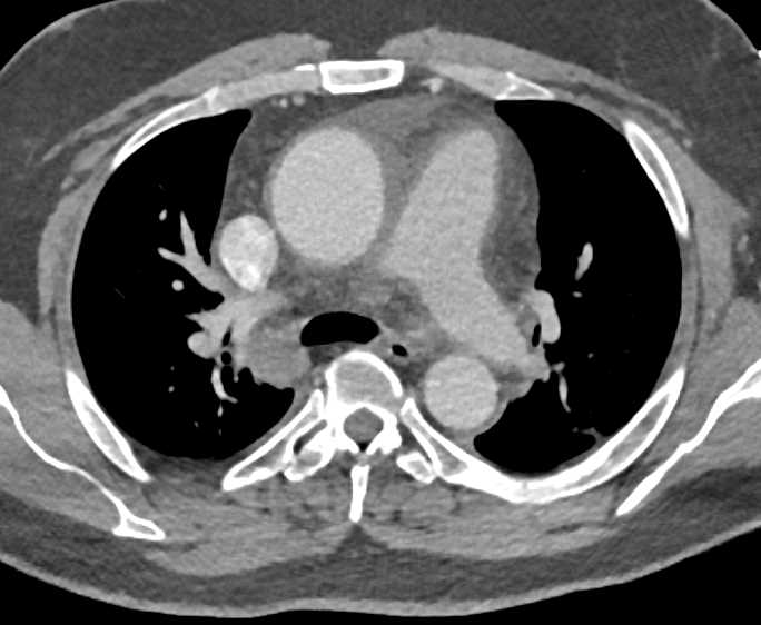 Pericardial Hemorrhage - CTisus CT Scan