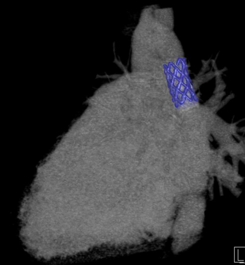 Stent Repair of Aortic Coarctation - CTisus CT Scan