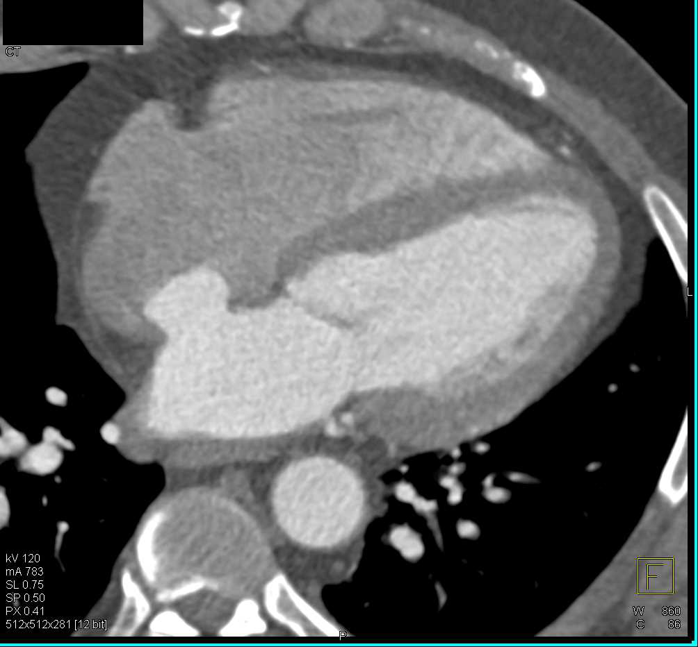 Atrial Septal Aneurysm (ASA) - CTisus CT Scan