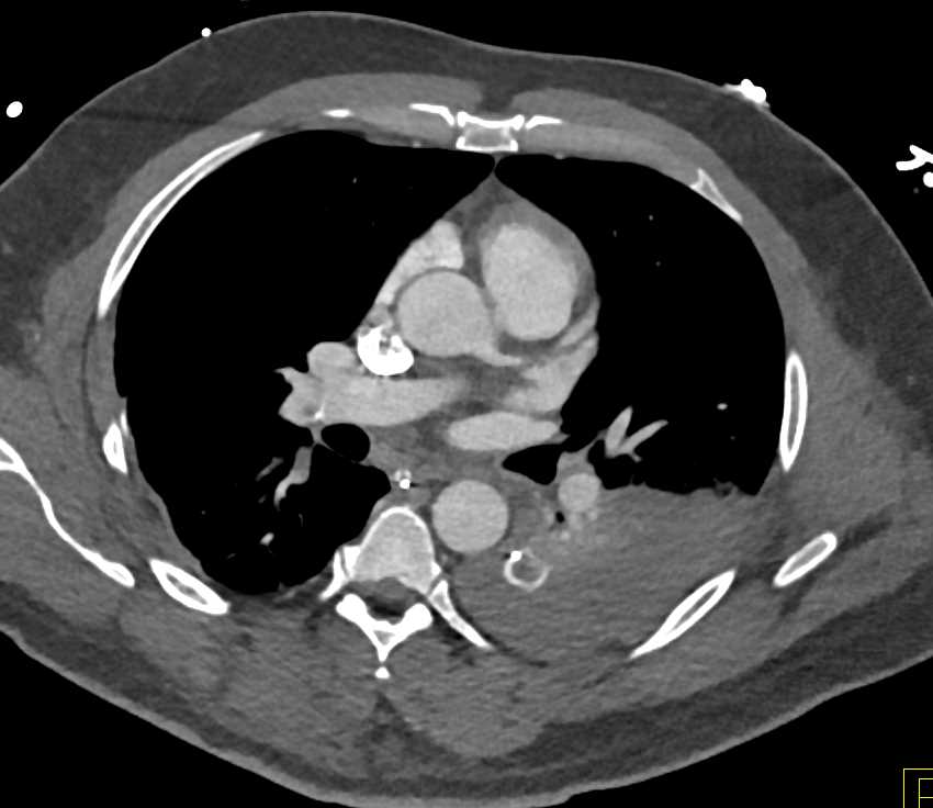 Clot in Aorta and Left Ventricle - CTisus CT Scan