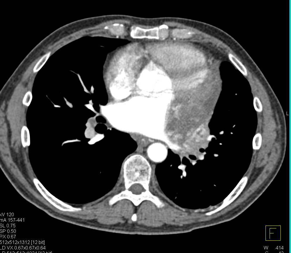 Renal Cell Carcinoma Metastatic to the Left Ventricle and Pancreas - CTisus CT Scan