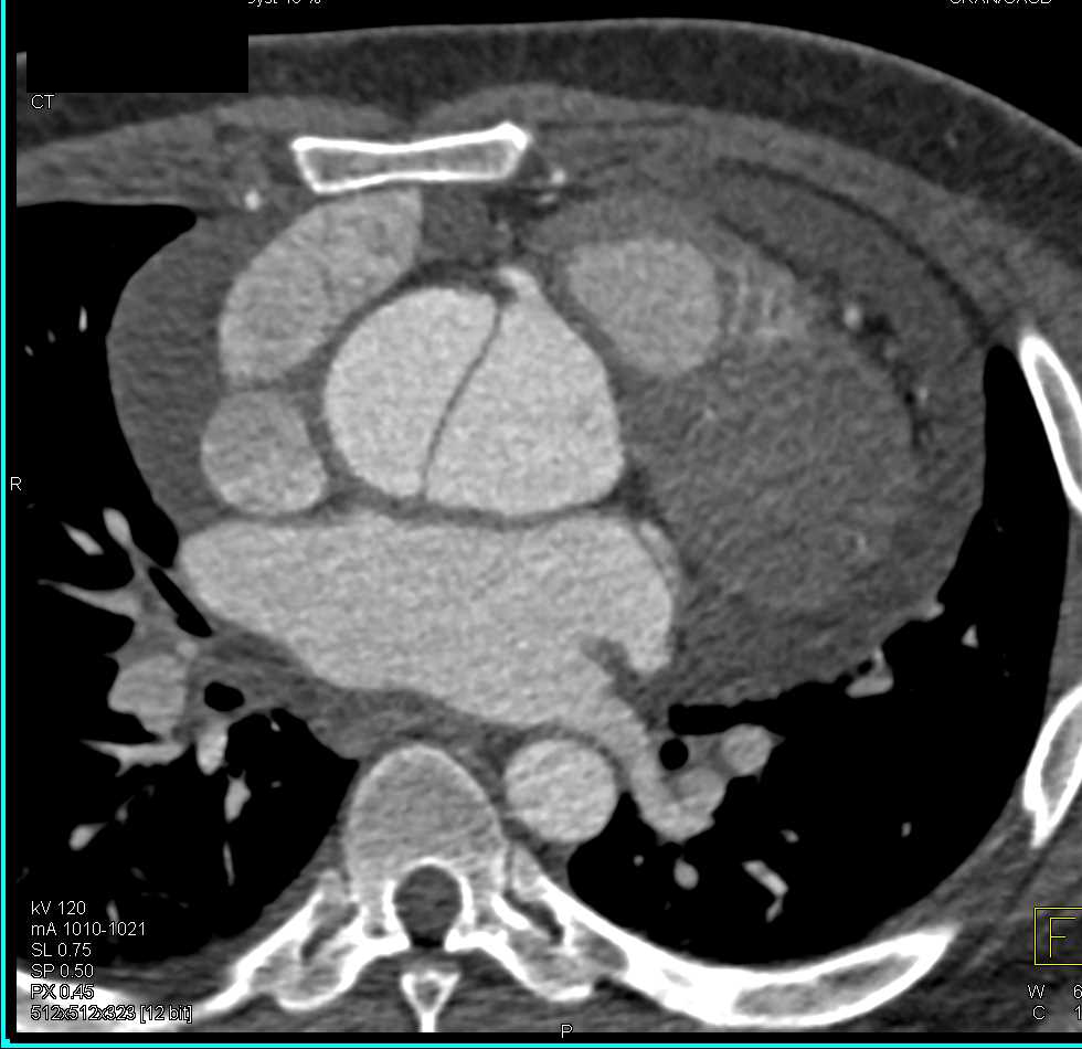 Type A Dissection with Hemopericardium - CTisus CT Scan