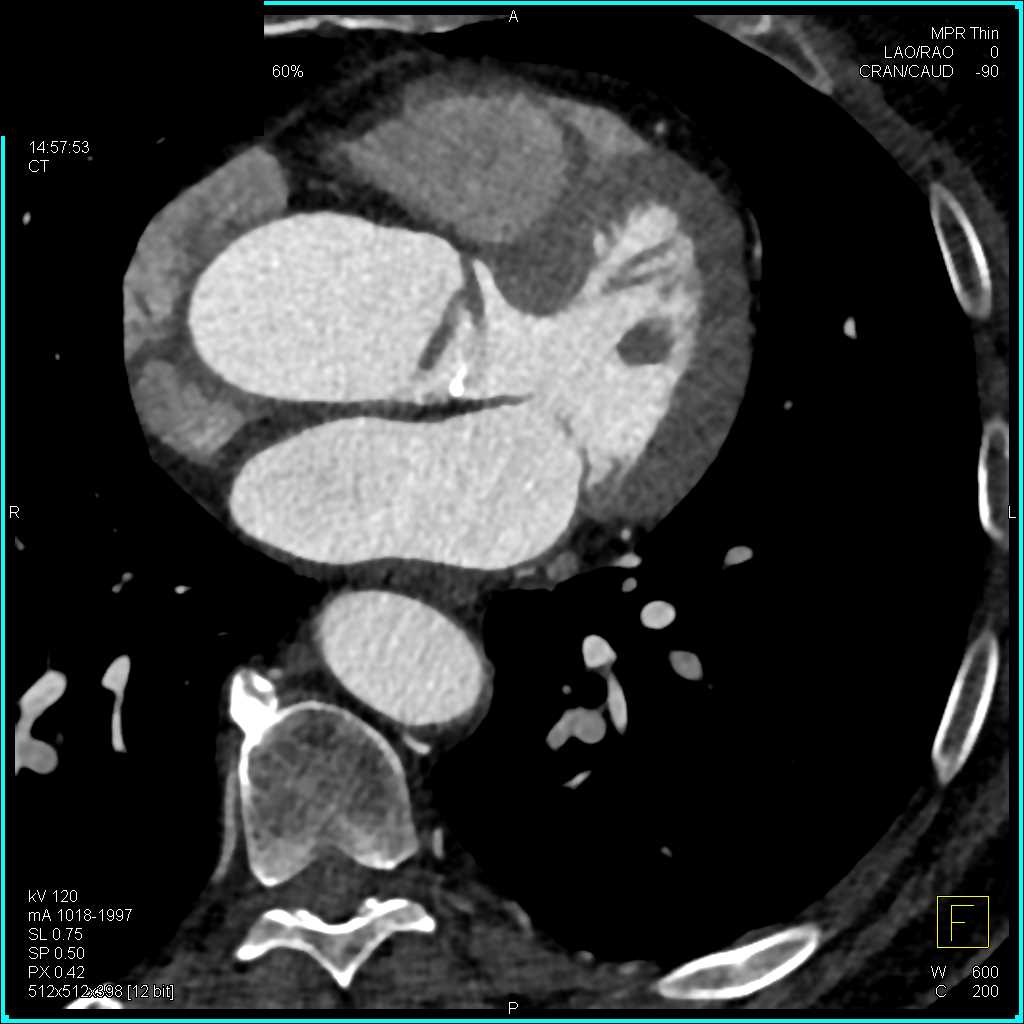 Type A Dissection - CTisus CT Scan