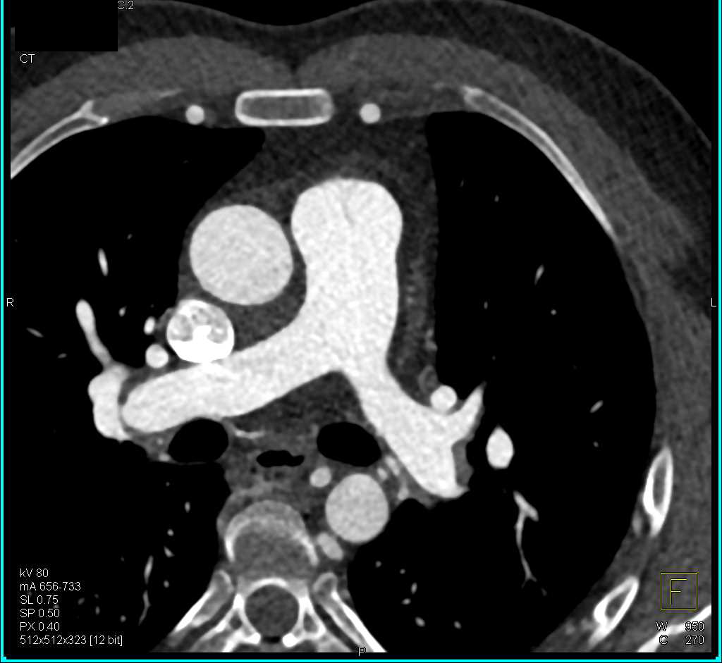 Coarctation of the Aorta and Bicuspid Aortic Valve - CTisus CT Scan