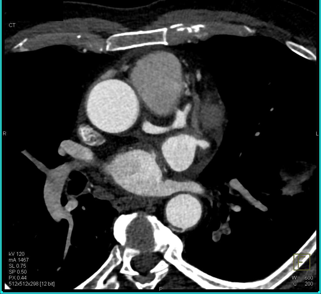 Coronary Artery Fistulae to the Main Pulmonary Artery - CTisus CT Scan