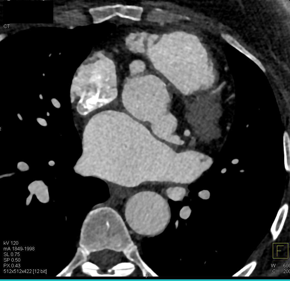 Aneurysm at Buttons for Reimplanted Coronary Arteries - CTisus CT Scan