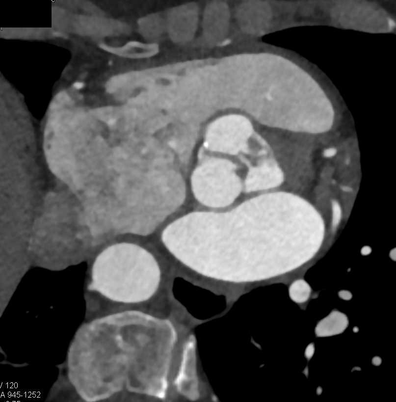 Thickening of the Aortic Valve Leaflets - CTisus CT Scan