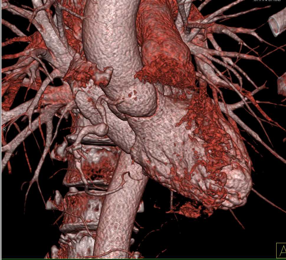 Right Coronary Artery Aneurysm - CTisus CT Scan