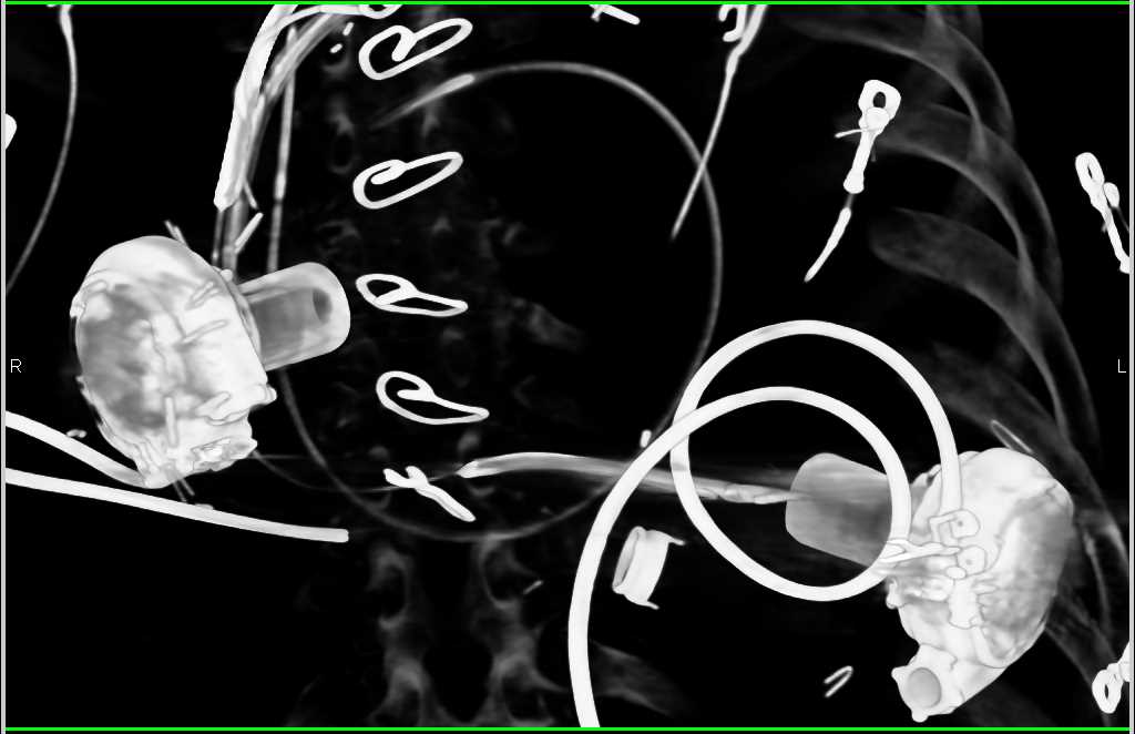 Left Ventricular Assist Device (LVAD) in Place - CTisus CT Scan