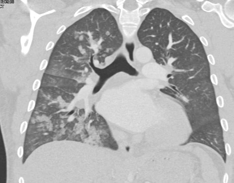 Patchy Infiltrates That Look Like COVID 19 - CTisus CT Scan