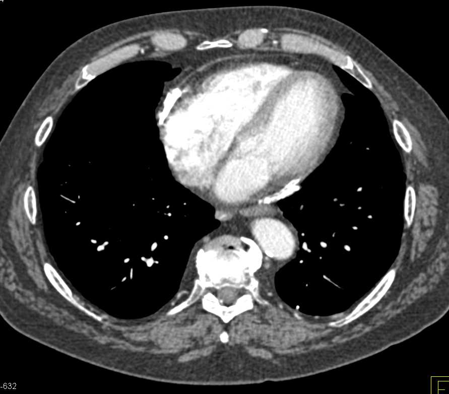 Pericardial Calcification - CTisus CT Scan