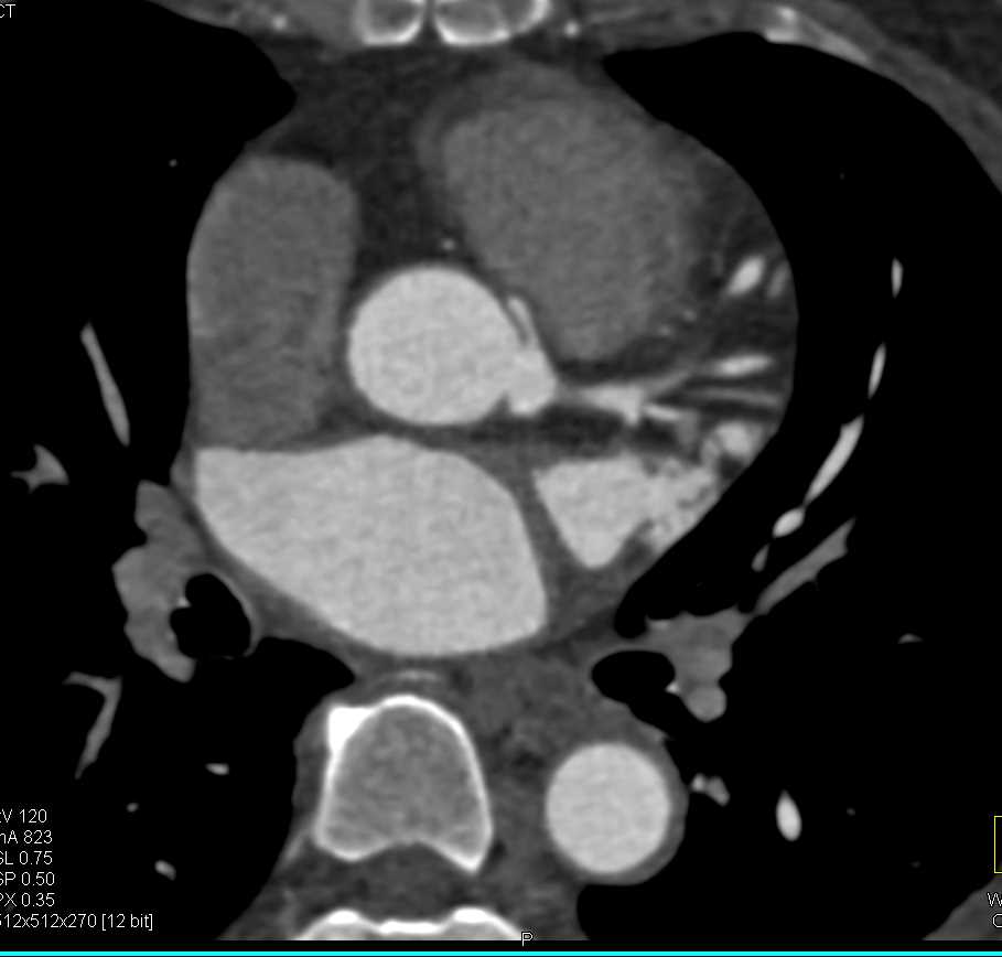 CCTA with Annomalous Right Coronary Artery Arising off Left Cusp in Malignant Configuration - CTisus CT Scan