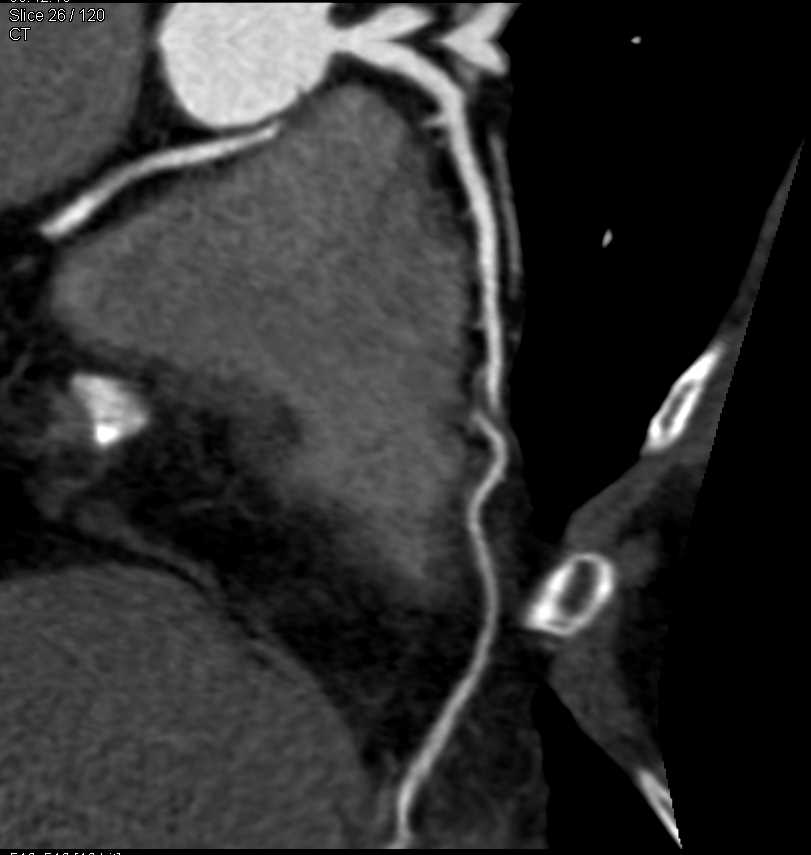 CCTA with Annomalous Right Coronary Artery Arising off Left Cusp in Malignant Configuration - CTisus CT Scan