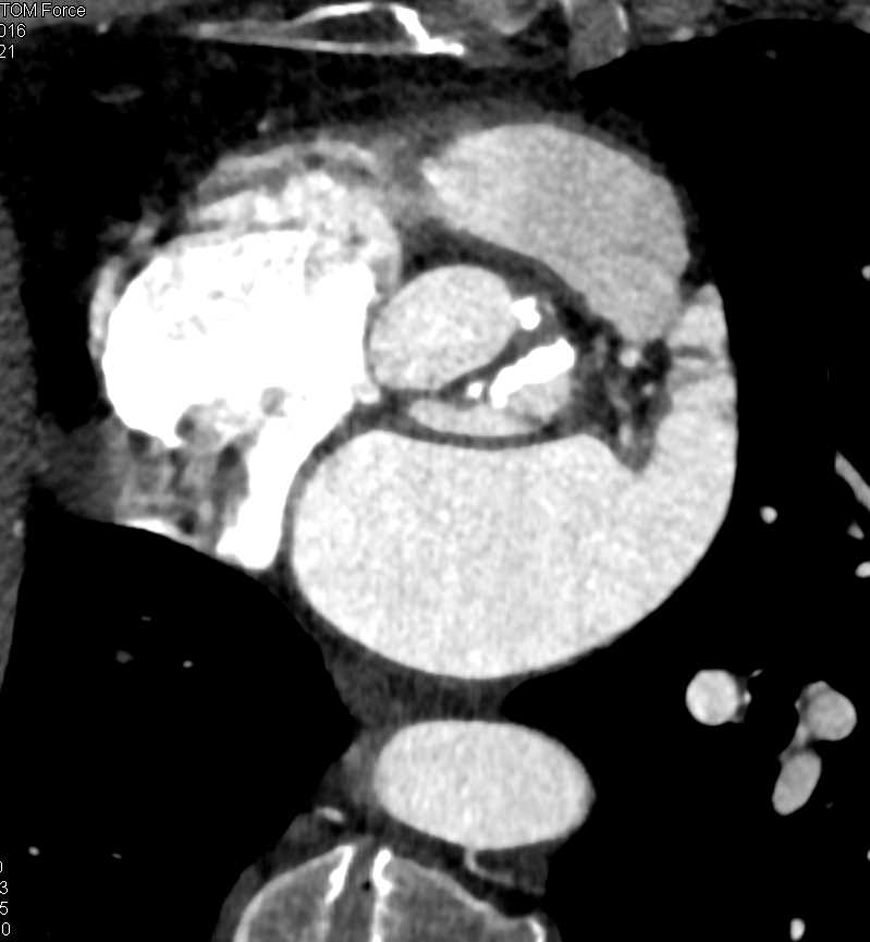 Bicuspid Aortic Valve - CTisus CT Scan