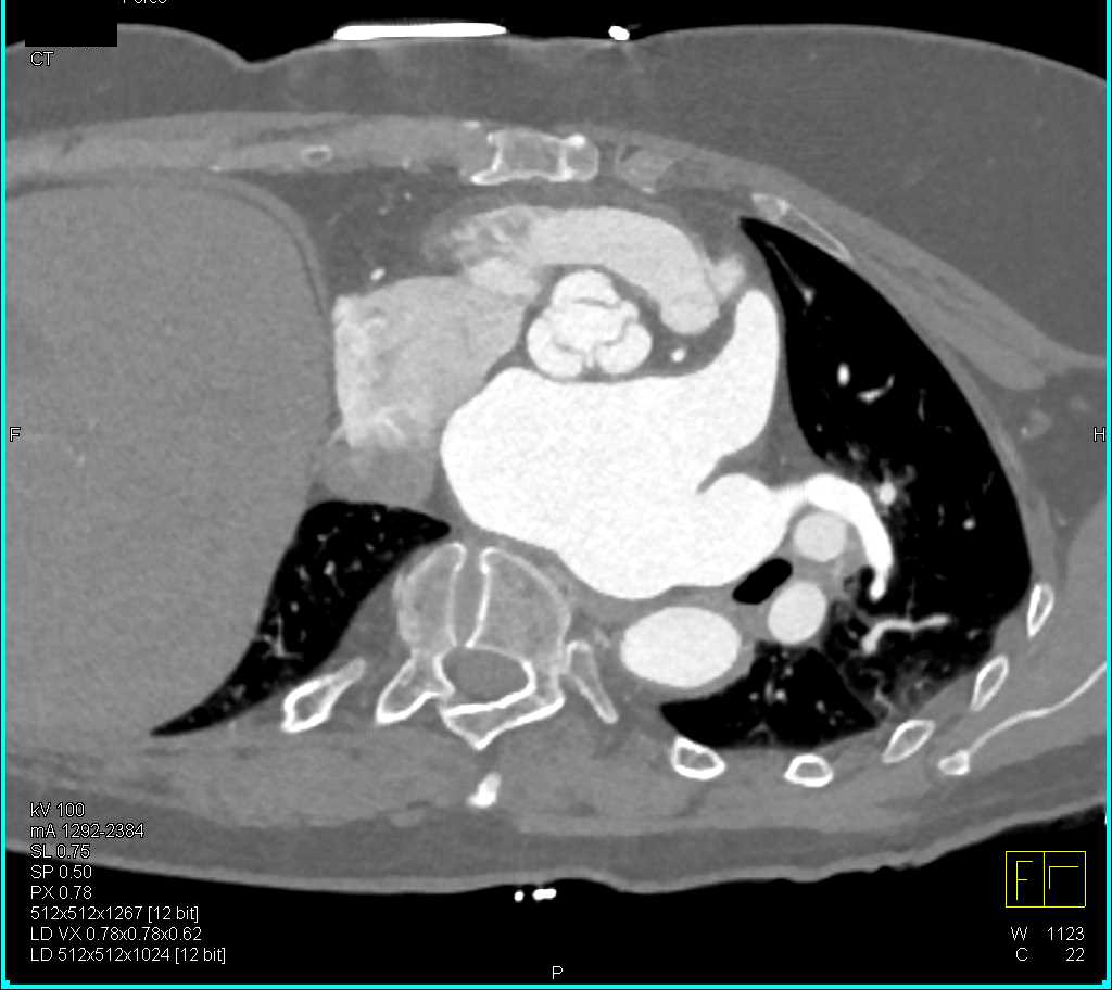 Aortic Valve in Profile - CTisus CT Scan