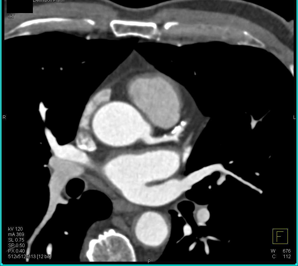 CCTA: Left Anterior Descending Artery (LAD) Stenosis with Calcified and Noncalcified Plaque - CTisus CT Scan