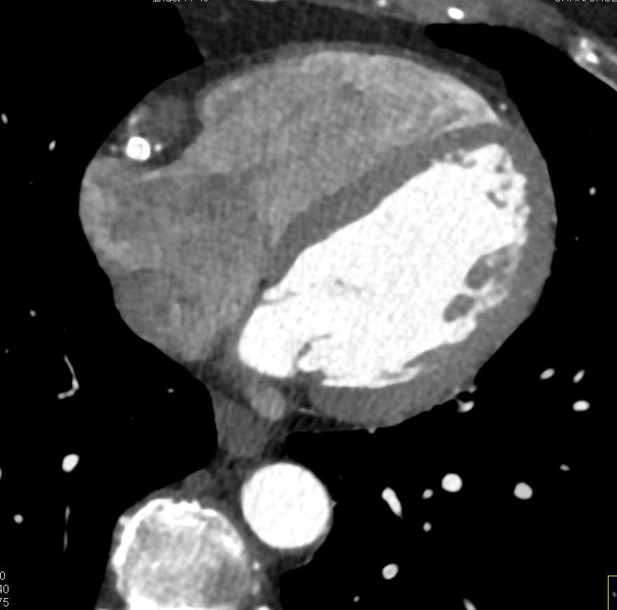 CCTA: Right Coronary Artery Aneurysm - CTisus CT Scan