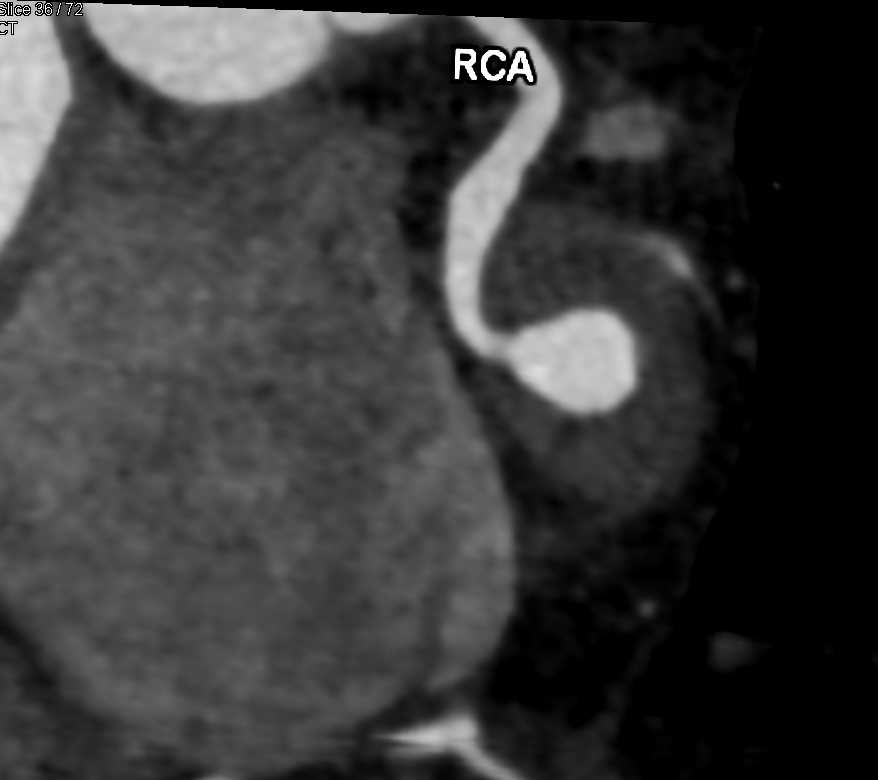 CCTA: Right Coronary Artery Aneurysm - CTisus CT Scan