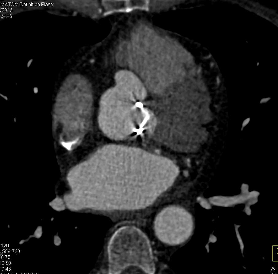 Aortic Valve Replacement (AVR) with Pseudoaneurysm Aortic Root - CTisus CT Scan