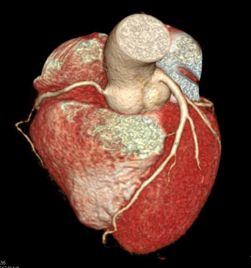 CCTA: Normal Coronary Arteries - CTisus CT Scan