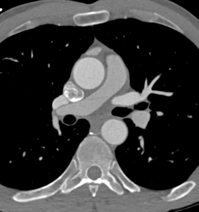 Papillary Fibroelastoma of the Aortic Valve - CTisus CT Scan