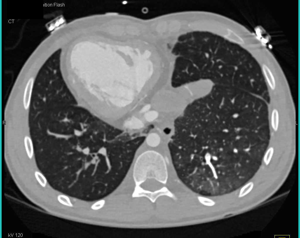 Situs Inversus and Grafts - CTisus CT Scan