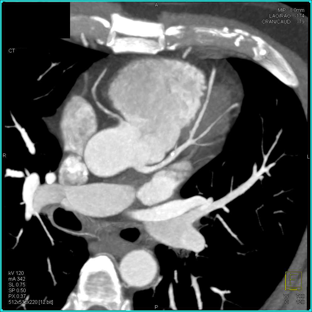 CCTA with Plaque in Left Anterior Descending Artery (LAD) - CTisus CT Scan