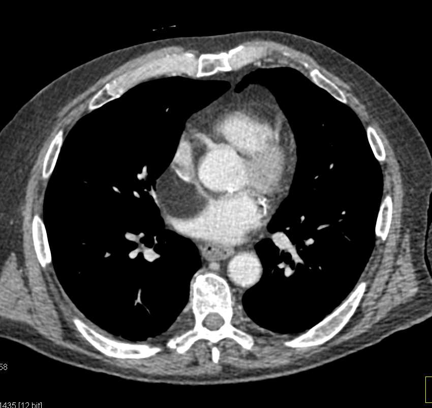 Intrapericardial Lipoma - CTisus CT Scan