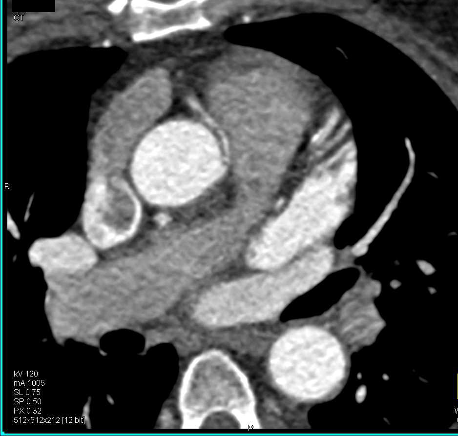 Right Coronary Arises off the Left Cusp - CTisus CT Scan