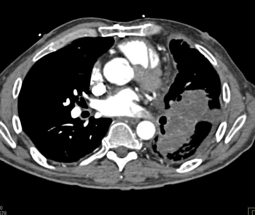 Primary Sarcoma of the Left Pulmonary Artery - CTisus CT Scan