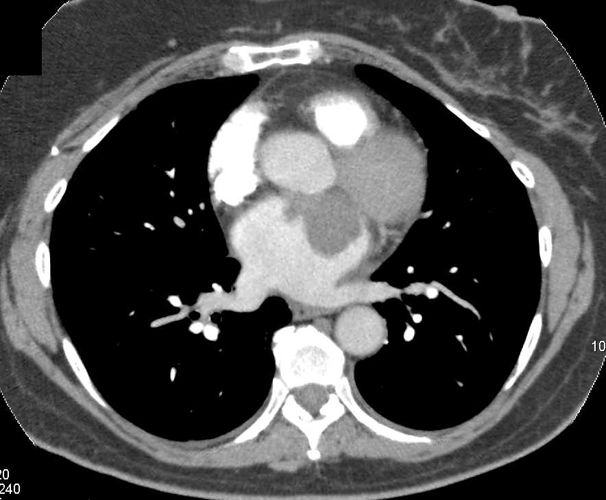 Left Atrial Myxoma - CTisus CT Scan