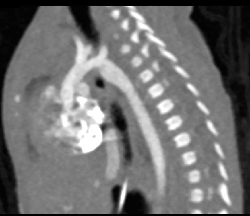 Coarctation of the Aorta - CTisus CT Scan