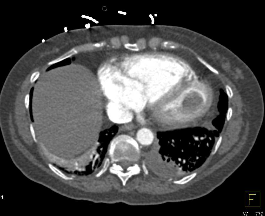 Thrombus Left Ventricle and Clot in Right Femoral Vein - CTisus CT Scan