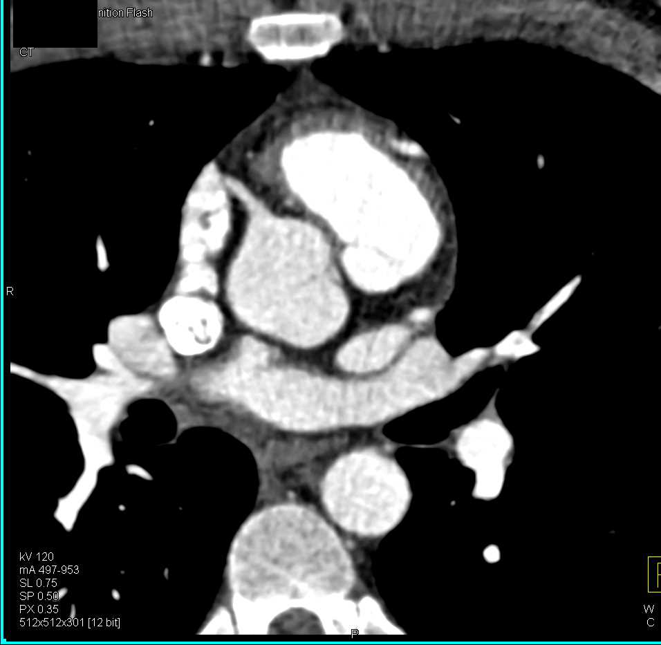 CCTA: Anomalous Origin of the Left Coronary off the Right Cusp - CTisus CT Scan