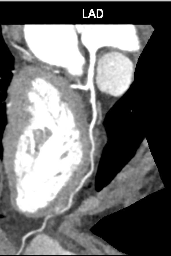 CTA with Myocardial Bridging - CTisus CT Scan