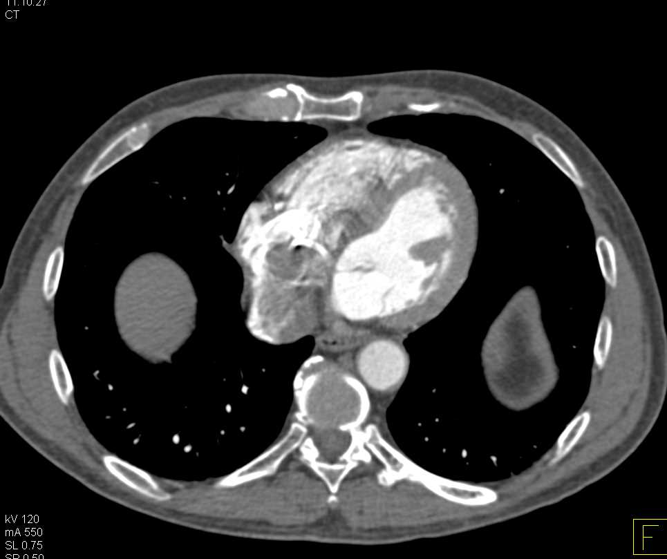 Clot in the Right Atrium - CTisus CT Scan