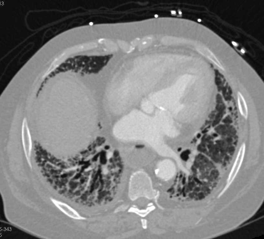 Interstitial Lung Disease (ILD) with markedly Inflamed Duodenum - CTisus CT Scan