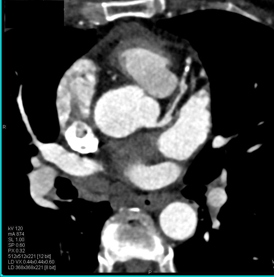 CCTA: High Stenosis Left Anterior Descending Artery (LAD) - CTisus CT Scan