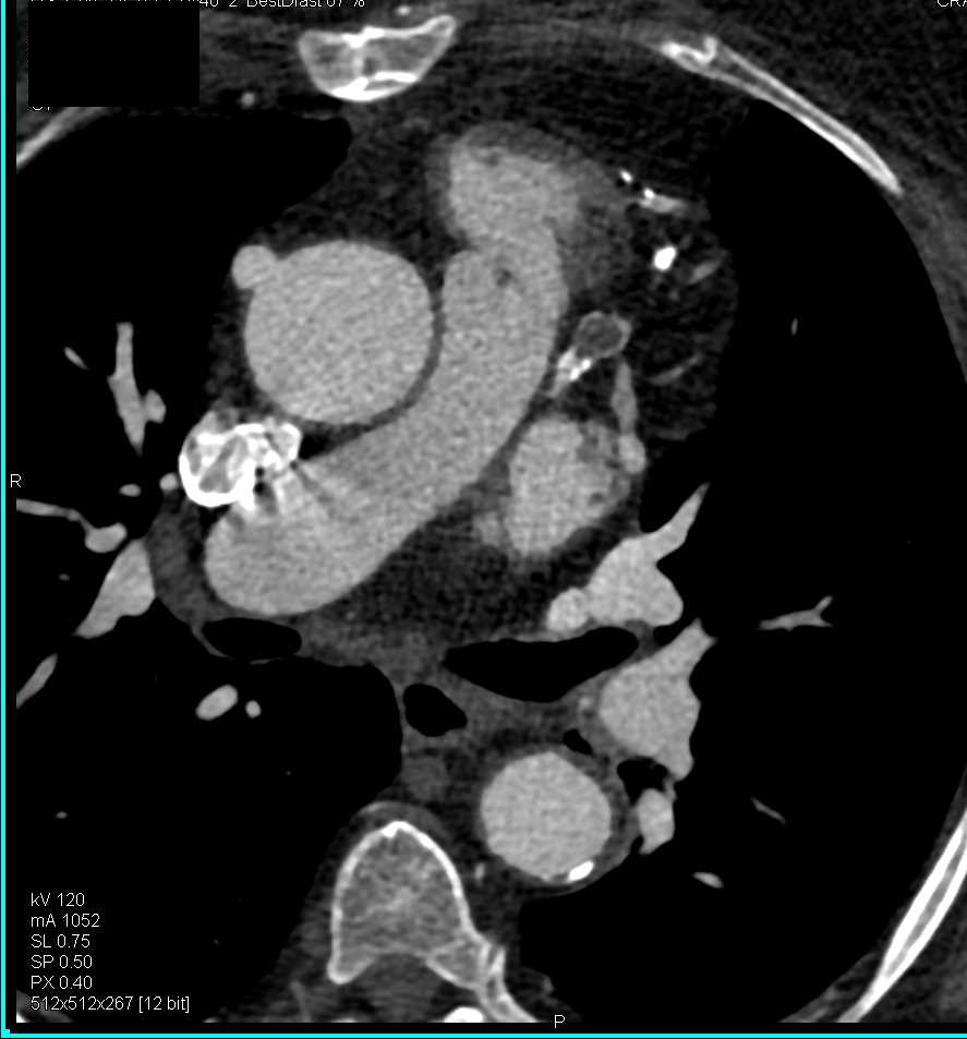 CCTA: Bypass Grafts and Left Anterior Descending Artery (LAD) Aneurysm - CTisus CT Scan