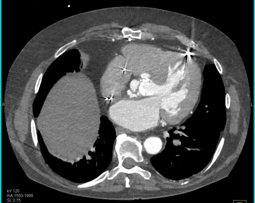 Pseudoaneurysms of the Aortic Root - CTisus CT Scan