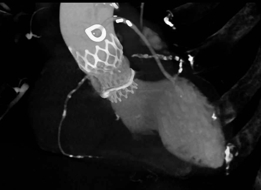 Transcatheter Aortic Valve Replacement (TAVR) Repair with Cinematic Rendering - CTisus CT Scan