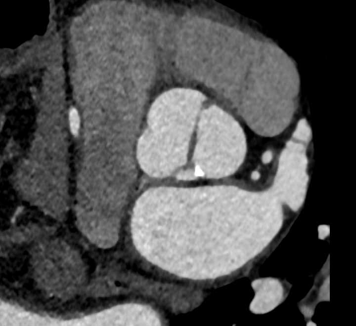 Bicuspid Aortic Valve - CTisus CT Scan