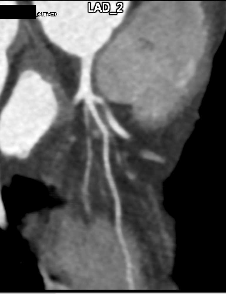 CCTA: Coronary Artery Plaque - CTisus CT Scan