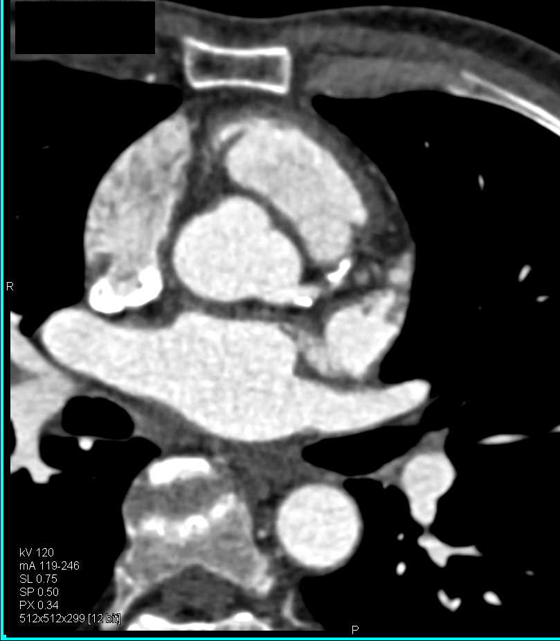 CCTA: Calcified Plaque in the Left Anterior Descending Artery (LAD) - CTisus CT Scan