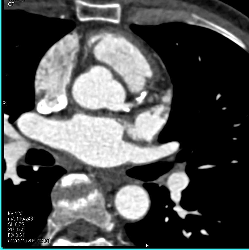 CCTA: Calcified Plaque in the Left Anterior Descending Artery (LAD) with Coronary Artery Disease (CAD) - CTisus CT Scan